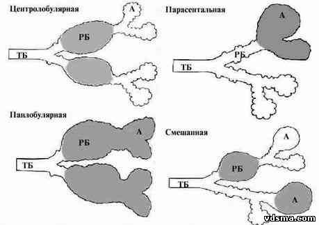 Различные виды эмфиземы лёгких, классификация эмфиземы лёгких