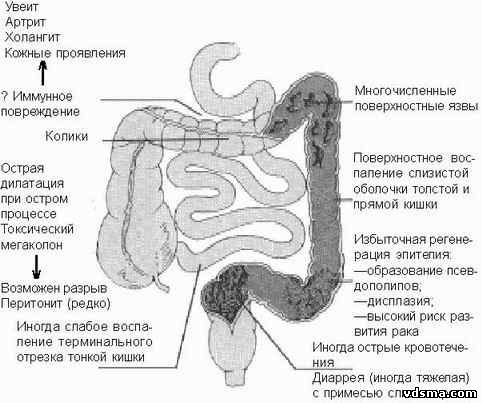 Патологические изменения при неспецифическом язвенном колите, НЯК